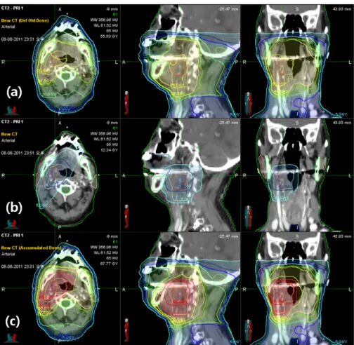 Fig.  2.  Example  case  of  a  64-year-old  man  with  T4N0  tonsil  carcinoma.  The  top  images  are  from  the  first  computed  tomography(CT)  scan,  and  show  the  isodose  curves  obtained  from  the  first  intensity-modulated  radiotherapy(IMRT)
