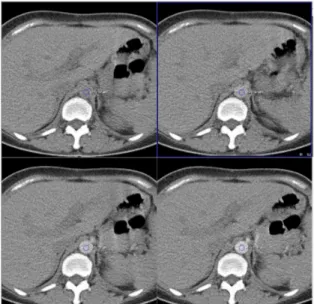 Fig.  1  Bolus  tracking  of  abdominal  aorta