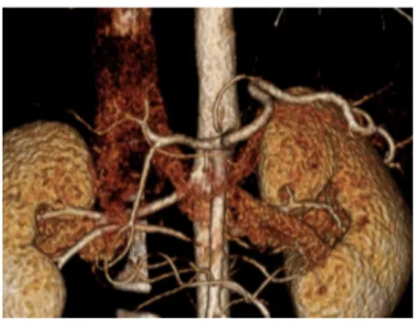 Fig.  12.  Type  Ⅹ  Left  gastric  artery,  celiac  axis,  and  SMA  each  originating  from  abdominal  aorta  with  common  hepatic  artery  and  splenic  artery  branching  from  celiac  axis.