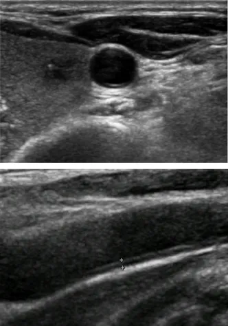 Figure  1.  Common  carotid  artery  intima-media  thickness  by  ultrasonography
