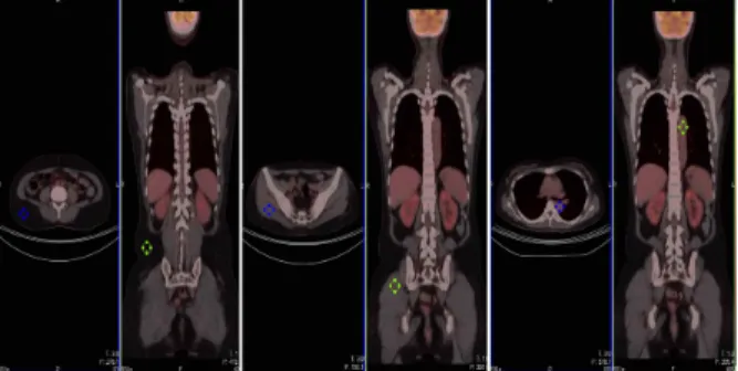 Fig. 5 Comparison of urinary excretion(%ID) of 18F-FDG  among  three  groups