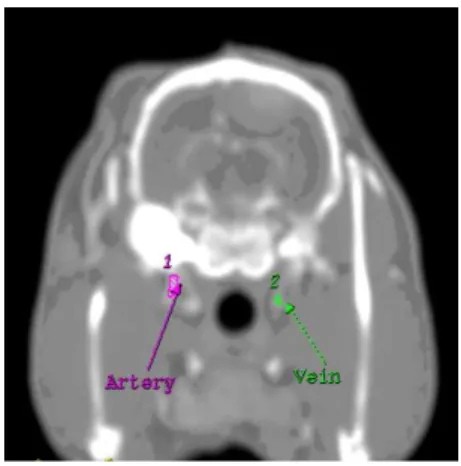 Figure 3 Define of entry artery and braining vein for  tumor  protocol  processing  at  perfusion  CT