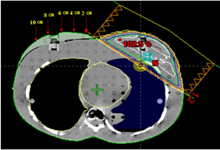 Fig.  1.  Set-up  position  on  the  surface  of  contralateral  breast CT image in Eclipse planning system