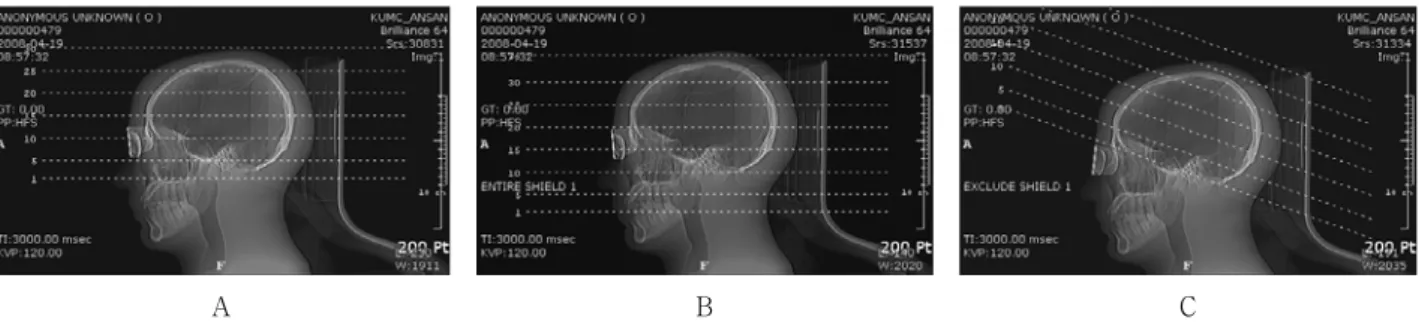 Fig. 2. Topographies of the Head CT examinations : A is included orbit, B is included entire head, C is excluded orbit