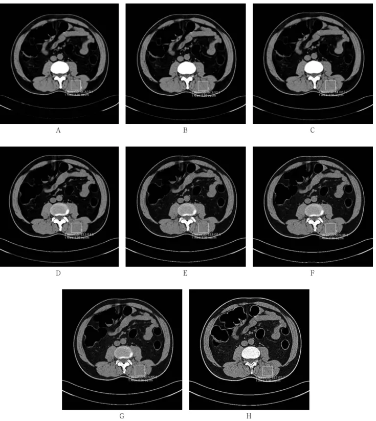 Fig. 3. The CT attenuation coefficient and noise measured of muscle tissue on non-enhanced abdominal scanning in the reconstructed  with  a  kernel  type