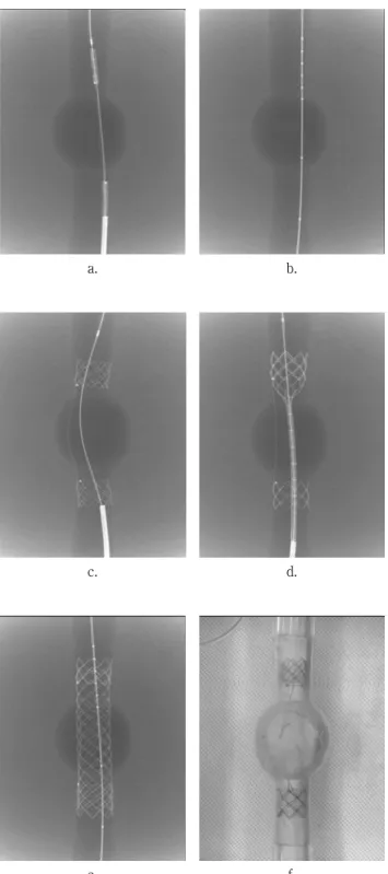 Fig. 4. Radiographs and a photograph show the technical  steps of separate stent-graft implantation