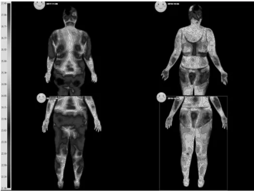 Fig.  2.  Comparison  of  back  tempera- tempera-ture  before  and  after  of  medical  treatment  (case  5).