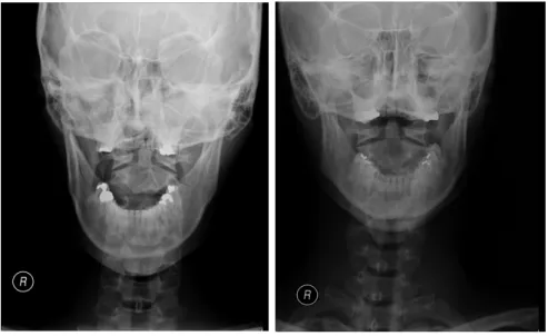 Fig.  1.  X-rays  of  C1-2  Open  Mouth  View.부소증 - 오한, 미열 37.2°C. 감기기운 살짝 있는 것 같다.3)  발병일2013년  결혼,  난임  기간  3년  7개월.4)  과거력  및  가족력2005년  위혹  수술(내시경)2010년  첫  결혼에서  임신후  9주  차  계류유산됨.2011년  축농증  수술,5)  산과력0-0-1-0  (인공수정  1회  실패)6)  현병력첫 번째 결혼에서 9주차 계류 유산