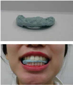 Fig. 1. Intraoral Balancing Appliance of occlusal balancing measures 36/32.  턱관절균형의학은 전통한의학의 침구경락음양론에서 말하는 자세음양균형 개념을 현대적으로 적용한 치료법으로서1) 상악 대비 하악 자세의 편차 즉 교합 및 턱관절 자세는 척추관절 자세와 연계되어 상보적, 통합적으로 조절되므로 척추관절을 중심으로 한 전신 자세조절기능을 평가하고 중재하는 도구가 되고, 또한 턱관절은 뇌신경계로의 