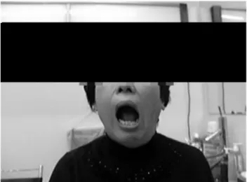 Fig.  1.  TMJ  appearance  tilted  to  left  side  during  swing  phase.不仁, 如是數年, 忍一連口脣, 頰車, 髮際皆痛, 不開口言語, 飮食皆妨, 在額與頰上常如糊, 手觸之則痛”이라고 그 증상이 나타나 있다