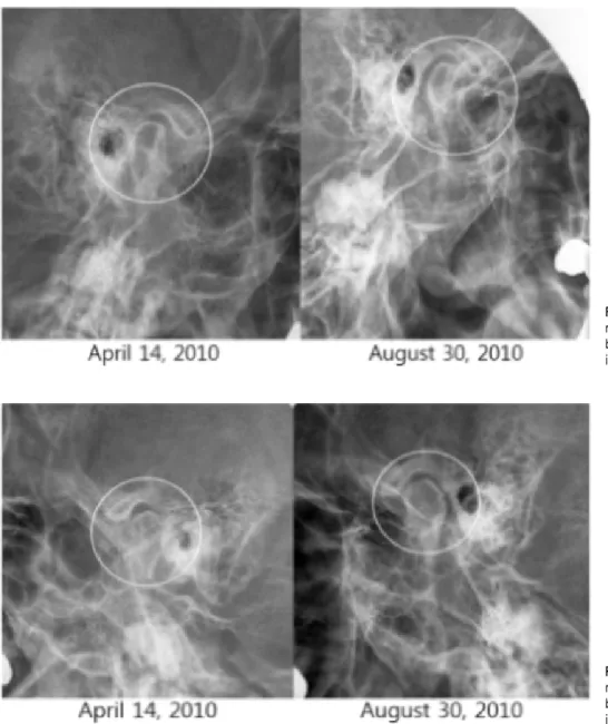 Fig. 5. Comparison of the right tempo- tempo-romandibular  joint  X-ray  images  at  baseline  and  at  5 th   month  after  the  initial  treatment  session.