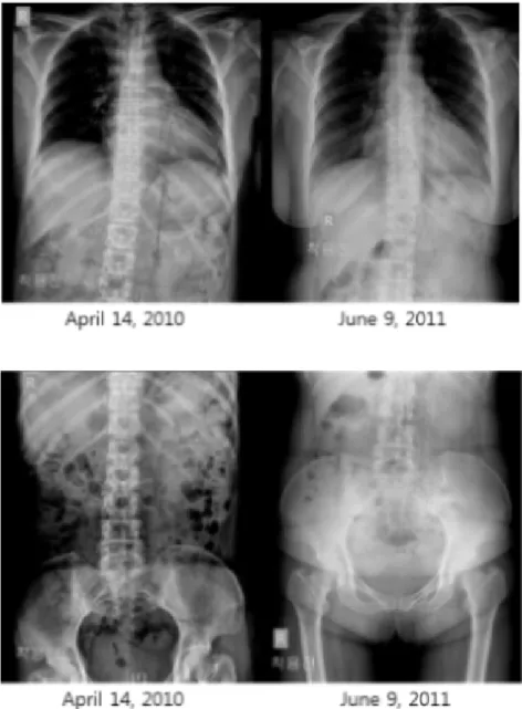 Fig.  8.  Comparison  of  thoracic  spine X-ray  images  at  baseline  and  at  14 th month after the initial treatment  ses-sion