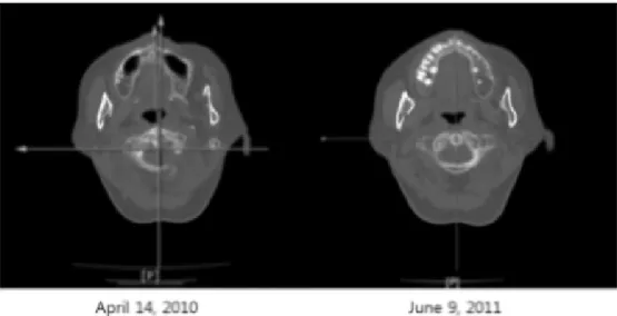 Fig. 10. Comparison of the 1 st  cervical vertebra computed tomogram images at baseline and at 14 th  month after the initial treatment session.