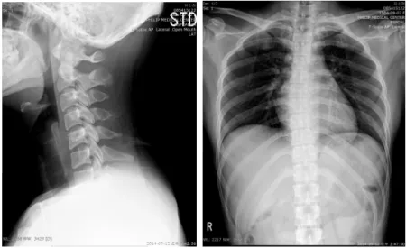 Fig. 2. iX-ray view of cervical (Lateral) and  thoracic  (PA)  region.