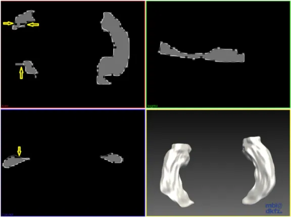 Fig. 1. Shape model of left and right hippocampi of a data set where the binary mask has few voxels missing/out of the contour of the shape model (arrowed)