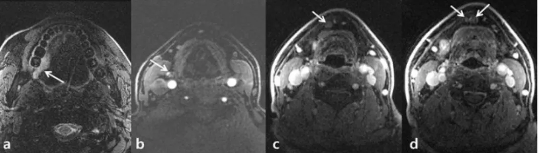 Figure  4.  51-year-old  patient  with  tongue  cancer  with  metastatic  LNs  outside 