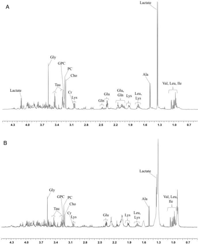 Figure 1: The HR-MAS MR spectra (11.7T) obtained using core needle biopsy specimens show the peaks of each  metabolite