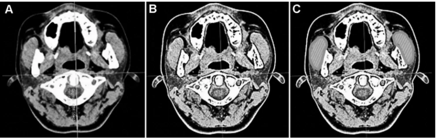 Figure 2. Three-dimensional computed tomography images. (A) Original axial image. (B) After adjusting window level to allow visualization of masseter muscle