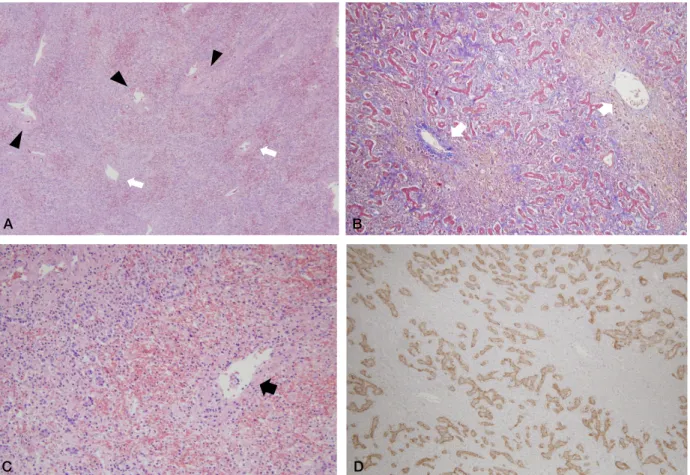 Figure 2. Histologic features of areas of extensive hepatocyte necrosis (A. H-E, ×40, B