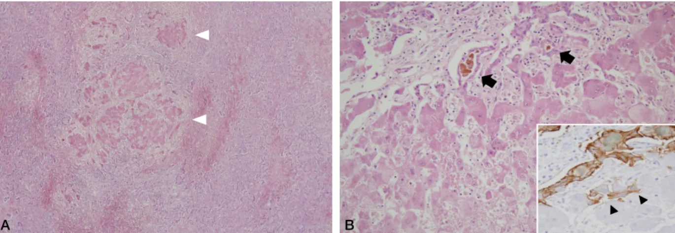 Figure 3. Small islands of regenerating hepatocytes are seen (white arrowheads) in the background of diffuse liver cell necrosis 
