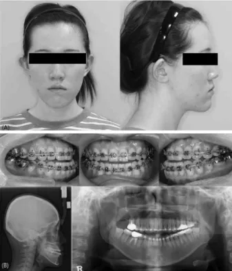 Fig. 1. An 22-year-old female with Mandibular prognathism, aper-