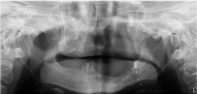 Fig. 1. Initial panoramic radiograph showing left maxilla defect 