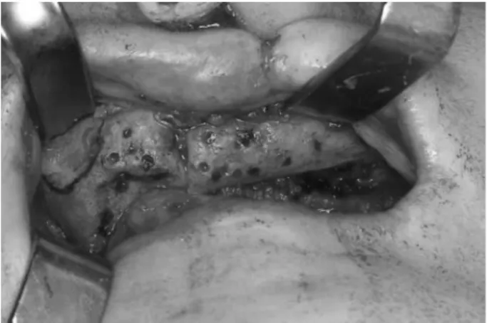 Fig. 8. Exposed maxilla and fibular bone for implant surgery. 