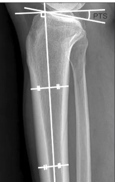 Fig. 1. The posterior tibial slope (PTS) was measured as the angle 