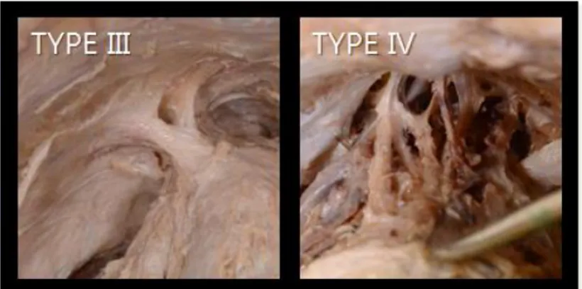 Figure  4.  Photograph  of  type  III  PPL  and  type  IV  PPL.  Left;  type  III  PPL  has  an  assistant fiber from the arcuate arch which reinforces the prostatic attachment
