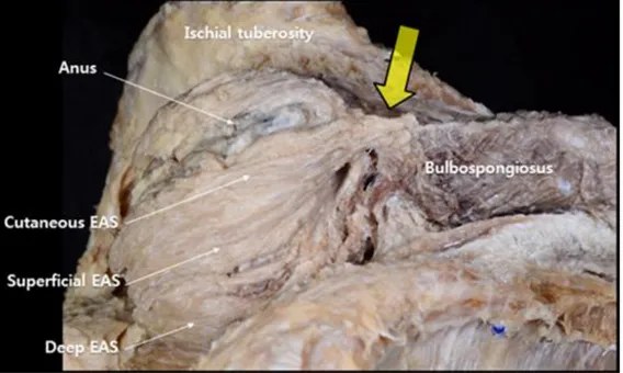 Figure 5. A photography of the cutaneous central band: Large arrow shows cutaneous  central  band;  Each  part  of  the  External  anal  sphincter  (EAS)  are  pointed  with  long  slender arrow