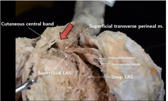 Figure  6.  Superficial  transverse  perineal  muscle;  Large  arrow  shows  perineal  body;  External anal sphincter (EAS)  