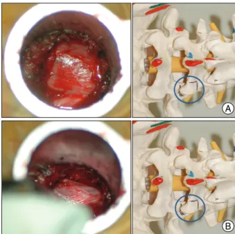 Fig. 2. A narrow groove is made using a high speed drill for osteotome at the inferior articular process (A), and at the superior articular process (B)