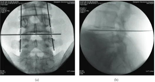 Figure 1: Fluoroscopic guidance in the AP view shows a mark on the skin at the disc space and the lateral pedicle line