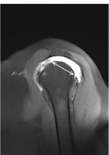 Figure 1. The tear size is defined as the maximum anteroposterior width on a fat- fat-suppressed T1-weighted sagittal oblique image