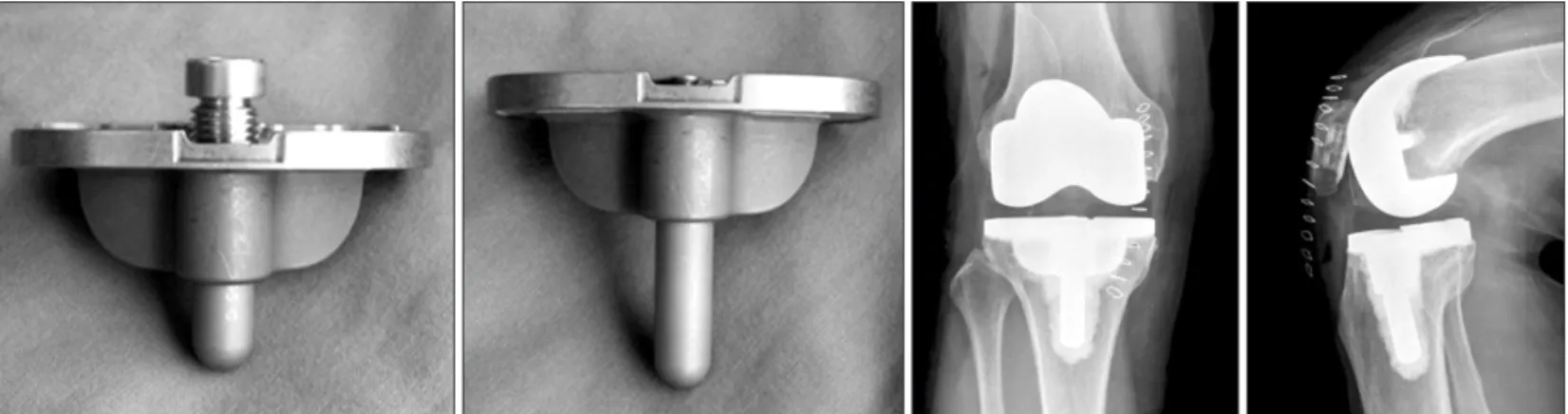 Fig. 1. Modular tibial implants are composed of NexGen MIS Precoat Stemmed Tibial Plates &amp; drop-down stem extensions