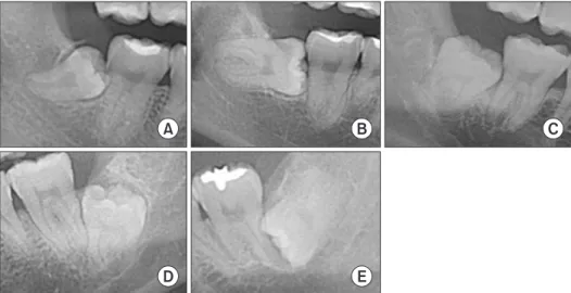 Fig. 2. Spatial relationship. Mesioangulated (A), horizontal (B), vertical (C), distoangulated (D), reverse mesioangulated (E) was defined 