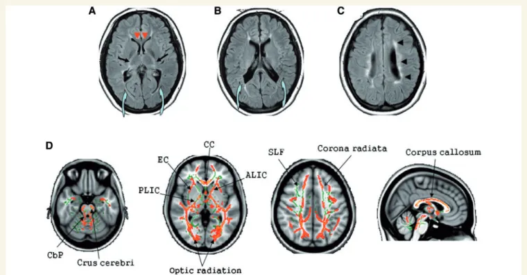 Figure 1 Periventricular white matter injury in patients with periventricular leucomalacia on conventional MRI and tract-based spatial