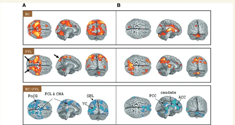 Figure 3 Grey matter volume reduction in patients with periventricular leucomalacia and correlation with motor dysfunction