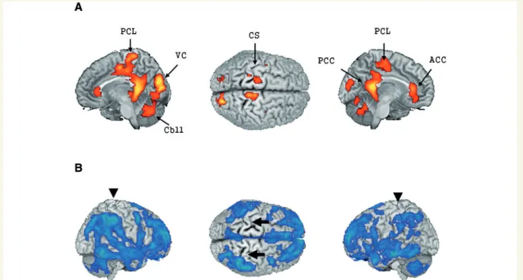Figure 5 GABA A receptor binding pattern in patients with periventricular leucomalacia and spastic diplegic cerebral palsy compared with