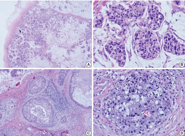 Fig. 1. Histologic features and biomarker status in mucinous carcinoma with extensive signet ring cell differentiation