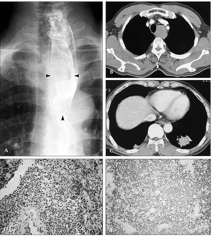 Fig. 1. A 65-year-old man with esophageal MALT lymphoma and concurrent BALT lymphoma of the lung