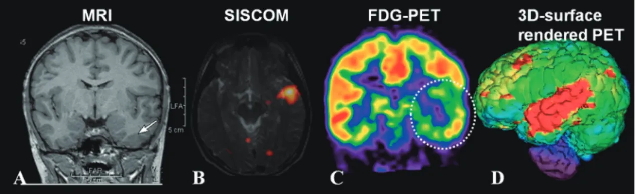 Fig. 1.  Convergent multimodal imaging in a 11-year-old boy with left temporal lobe epilepsy
