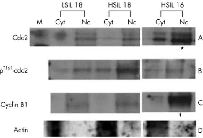 Figure 3 Western blotting in the nuclear fractional assay for cdc2 and cyclin B1. Human cervical swab samples with human papillomavirus infection showed increased expression of cdc2, T161-cdc2, and cyclin B1, mostly in the nuclei