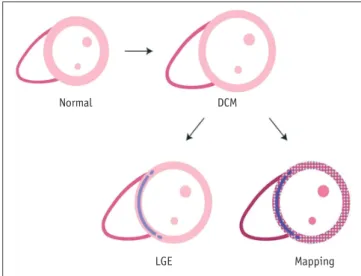 Fig. 7. T1 mapping in dilated cardiomyopathy (DCM).  DCM is  characterized by ventricular dilation and systolic dysfunction without  other loading conditions