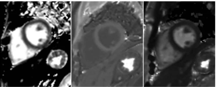 Fig. 1. Representative short-axis images of native T1, post-contrast T1 and T2, and extracellular volume fraction (ECV) maps of  control subject