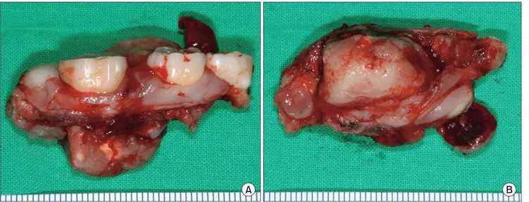 Fig. 4. Resected specimen showing well-encapsulated mass. A. Buccal side view. B. Lower part side view.