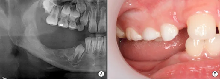 Fig. 6. Post-operative panoramic X-ray (A) and clinical photo (B) after 18 months.