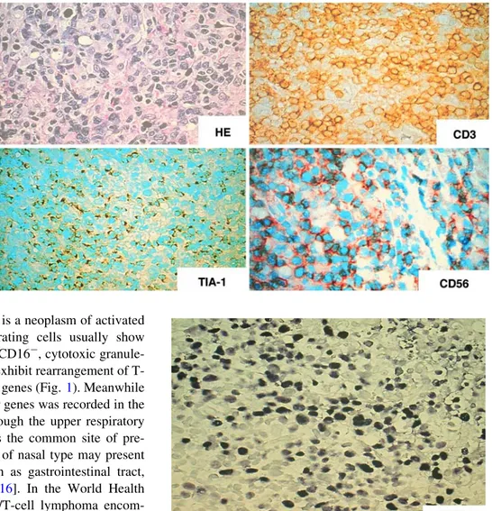 Fig. 2 In situ hybridization with EBER-1 probe reveals positive signals in the nucleus of proliferating cell