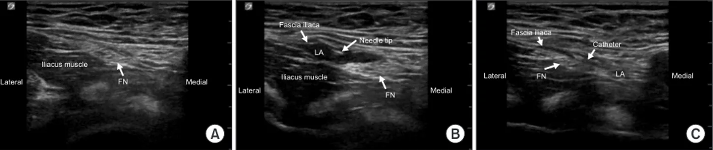 Fig. 1. Ultrasound images revealing the relevant sono-anatomy for femoral nerve (FN) block before (A) and after (B) local anesthetic (LA) injection,  and perineural catheter (C)