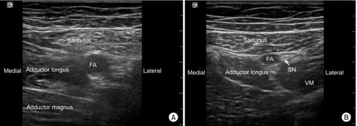 Fig. 2. Ultrasound images of the short-axis view of halfway between the anterior superior iliac spine and base of the patella (A) and proximal end of  the adductor canal (B)